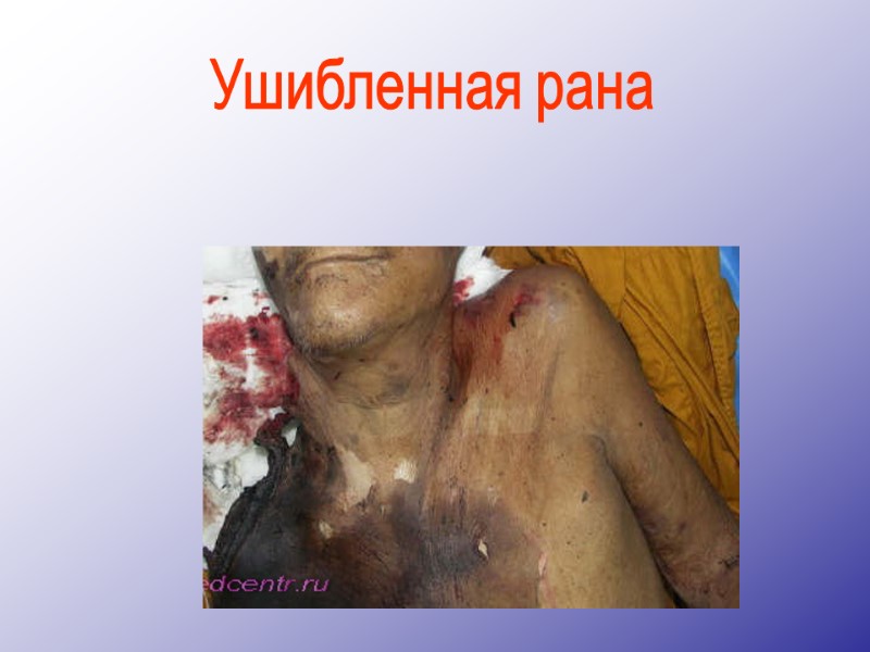 Ушибленная рана